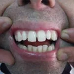 ציפוי חרסינה — 2
