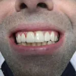 ציפוי חרסינה — 3