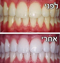 הלבנת שיניים — 1