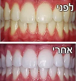 הלבנת שיניים — 1