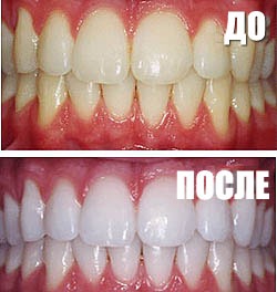 Отбеливание зубов — 1