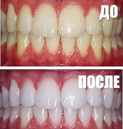 Отбеливание зубов — 1
